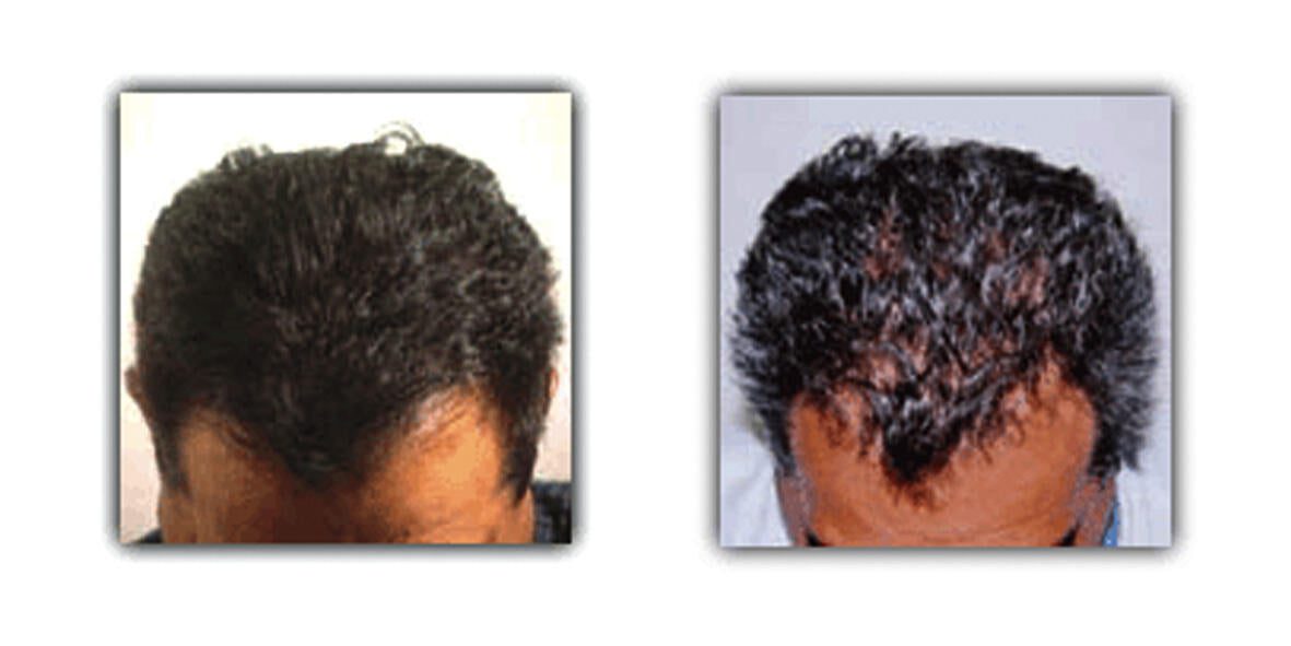 Peine con infrarrojos y láser para el crecimiento y caída del cabello